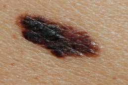 سرطان الجلد