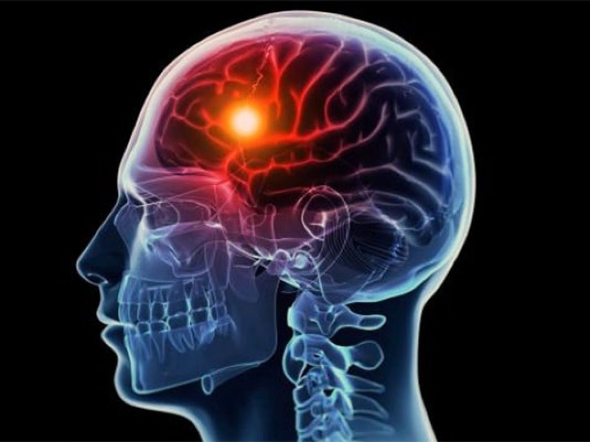 طريقة علاج الجلطة الدماغية