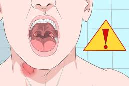 اسباب التهاب الحلق