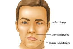 علاج التهاب العصب السابع