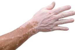 طرق علاج البهاق الطبيعية و بالادوية