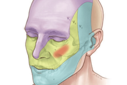 طرق علاج التهاب العصب الخامس