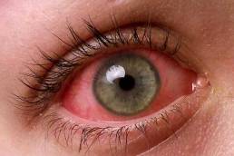 علاج حساسية العين