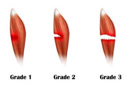 علاج تمزق العضلات