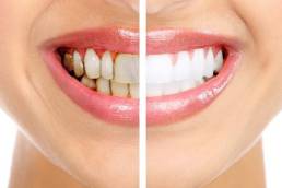 علاج التهاب اللثة الشديد