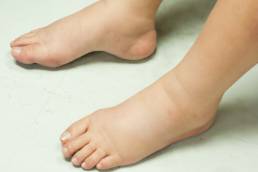 تورم القدمين