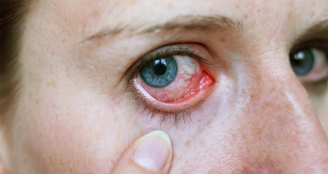 متلازمة بهجت